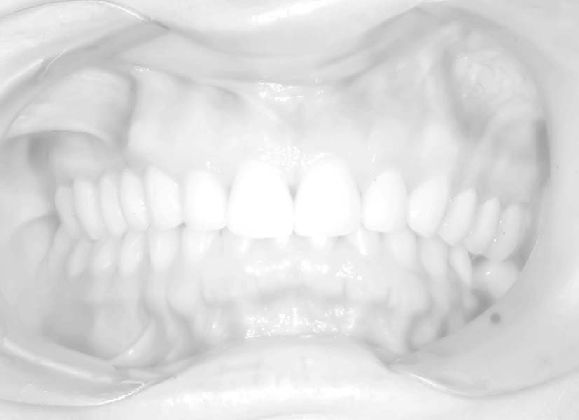protezy zębów bielsko-biała