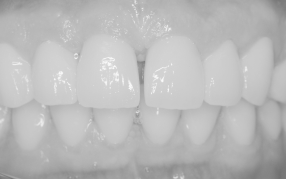 protezy zębowe bielsko