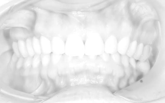 wybielanie zębów bielsko