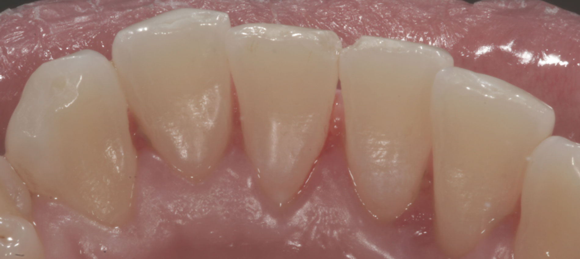 skaling zębów bielsko biała