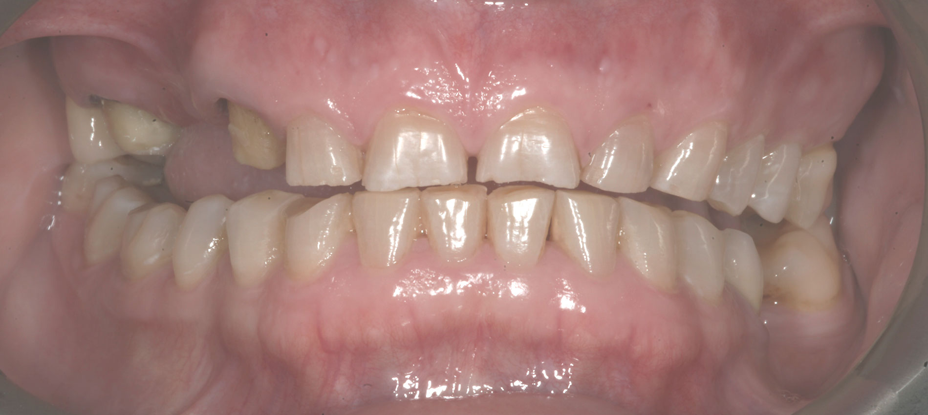 protezy zębów bielsko