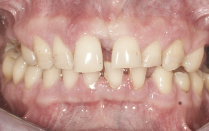 protezy zębów bielsko