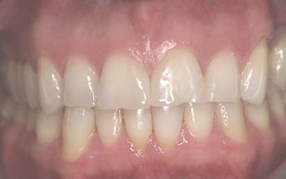 implanty zębowe bielsko
